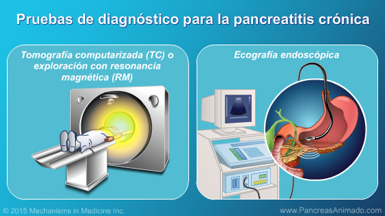 Pancreatitis crónica - Slide Show - 13